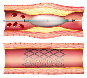 stent in the heart