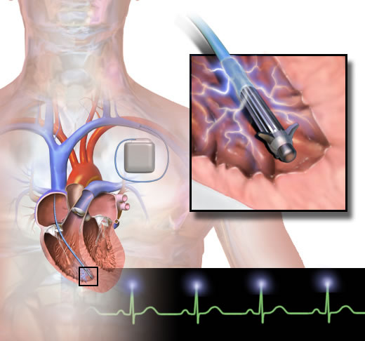 implanted heart monitor