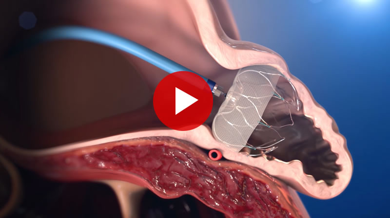 Cardiac Watchman Illustration with Video Link