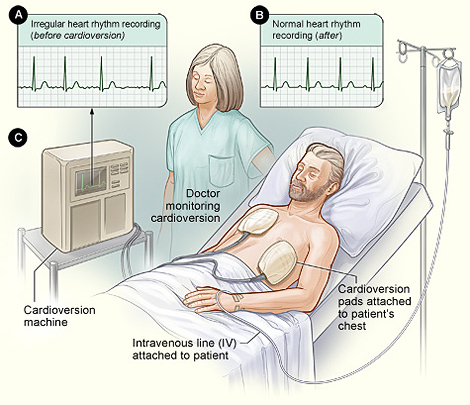 Illustration of the cardioversion procedure.